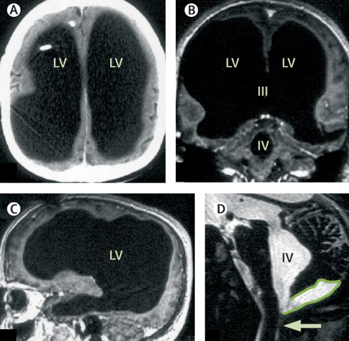 Scientists research man missing 90% of his brain who leads a normal life